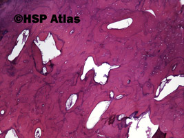 1. Choroba Pageta (Paget disease), 4x