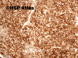 5. CD117, Ewing sarcoma, PNET 20x
