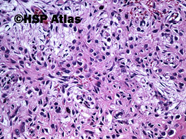 7. Osteoblastoma,guz szczęki, kobieta, 64 lata, 20x