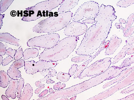 1. Papillary fibroelastoma, guzek prawego płatka wieńcowego, kobieta, 68 lat, 4x
