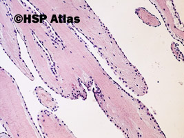 2. Papillary fibroelastoma, guzek prawego płatka wieńcowego, kobieta, 68 lat, 10x