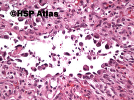 10. Naczyniakomięsak, typ epitelioidalny (angiosarcoma, epithelioid type), 20x