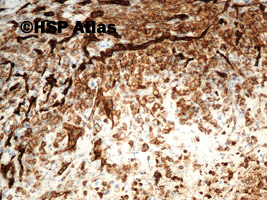 12. CD31, angiosarcoma, epithelioid type, 10x