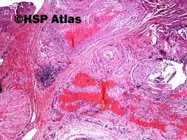 2. Naczyniak tętniczo-żylny (arteriovenous haemangioma), 4x