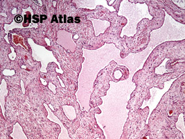 2. Naczyniak chłonny jamisty (cavernous lymphangioma), 4x