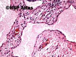 5. Naczyniak chłonny jamisty (cavernous lymphangioma), 20x