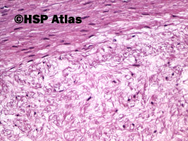 10. Blaszka miażdżycowa (atherosclerotic plaque), 20x