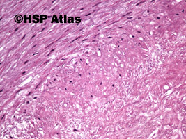 11. Blaszka miażdżycowa (atherosclerotic plaque), 20x