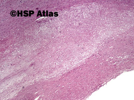 2. Blaszka miażdżycowa (atherosclerotic plaque), 4x