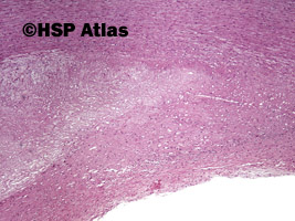 3. Blaszka miażdżycowa (atherosclerotic plaque), 4x