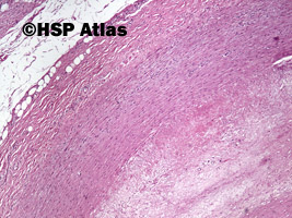 4. Blaszka miażdżycowa (atherosclerotic plaque), 4x