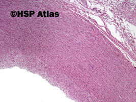 5. Blaszka miażdżycowa (atherosclerotic plaque), 4x