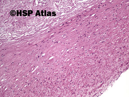 6. Blaszka miażdżycowa (atherosclerotic plaque), 10x