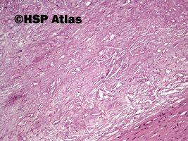 7. Atherosclerotic plaque, 10x