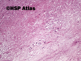 8. Blaszka miażdżycowa (atherosclerotic plaque), 10x