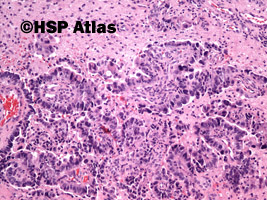 2. Przerzut raka gruczołowego płuc (lung adenocarcinoma metastasis to brain), 10x
