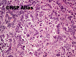 3. Lung adenocarcinoma metastasis to brain, 10x