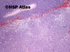 1. Chłoniak rozlany z dużych komórek B  (DLBCL, Diffuse large B cell lymphoma),  rozsiane guzy płata ciemieniowego i potylicznego mózgu, 74 lata, kobieta, 4x