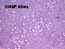 2. Chłoniak rozlany z dużych komórek B  (DLBCL, Diffuse large B cell lymphoma), 10x