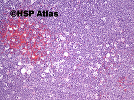 3. Chłoniak rozlany z dużych komórek B  (DLBCL, Diffuse large B cell lymphoma), 10x