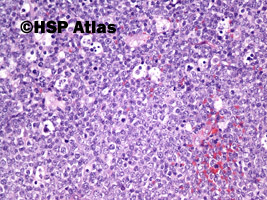 4. Chłoniak rozlany z dużych komórek B  (DLBCL, Diffuse large B cell lymphoma), 20x