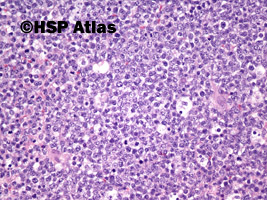 5. Chłoniak rozlany z dużych komórek B  (DLBCL, Diffuse large B cell lymphoma), 20x