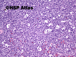 6. Chłoniak rozlany z dużych komórek B  (DLBCL, Diffuse large B cell lymphoma), 20x