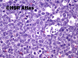7. Chłoniak rozlany z dużych komórek B  (DLBCL, Diffuse large B cell lymphoma), 40x