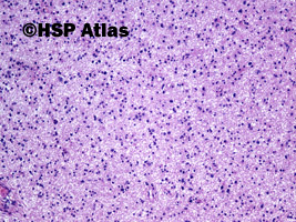 1. 1. Diffuse astrocytoma, WHO II, 10x