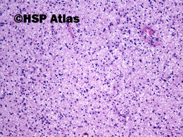 2. Diffuse astrocytoma, WHO II, 10x