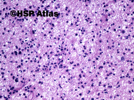 3. Gwiaździak rozlany (diffuse astrocytoma), WHO II, 20x