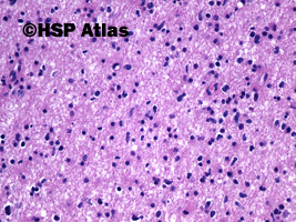 4. Diffuse astrocytoma, WHO II, 20x