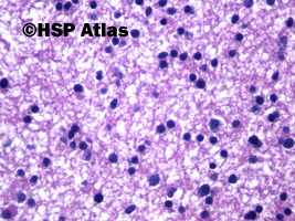 5. Gwiaździak rozlany (diffuse astrocytoma), WHO II, 40x