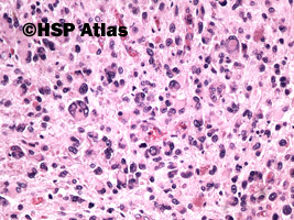 1. Glejak wielopostaciowy olbrzymiokomórkowy (Giant cell glioblastoma), 20x