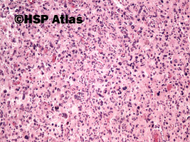 2. Glejak wielopostaciowy olbrzymiokomórkowy (Giant cell glioblastoma), 10x
