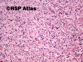 3. Glejak wielopostaciowy - typ olbrzymiokomórkowy (Giant cell glioblastoma), 10x