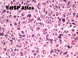 4. Glejak wielopostaciowy olbrzymiokomórkowy (Giant cell glioblastoma), 20x