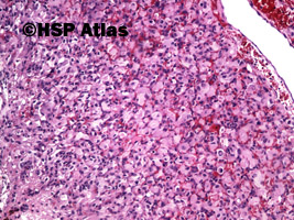 1. Naczyniak krwionośny zarodkowy (hemangioblastoma), guz móżdżku, kobieta, 60 lat, 10x