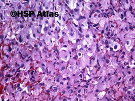3. Naczyniak krwionośny zarodkowy (hemangioblastoma), 20x