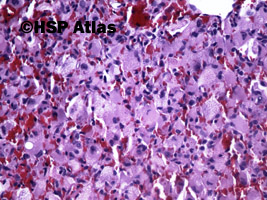 4. Naczyniak krwionośny zarodkowy (hemangioblastoma), 20x