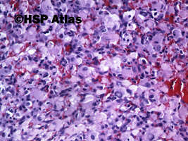 5. Naczyniak krwionośny zarodkowy (hemangioblastoma), 20x