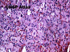 6. Naczyniak krwionośny zarodkowy (hemangioblastoma), 20x