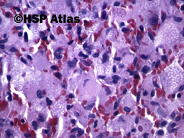 7. Naczyniak krwionośny zarodkowy (hemangioblastoma), 40x