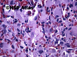 8. Naczyniak krwionośny zarodkowy (hemangioblastoma), 40x