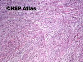 1. Oponiak włóknisty [fibrous (fibroblastic) meningioma], WHO I, 4x