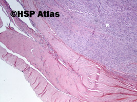 2. Oponiak włóknisty [fibrous (fibroblastic) meningioma], WHO I, 4x