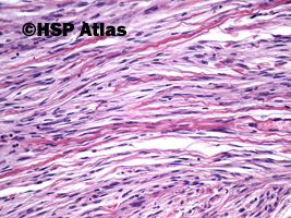 6. Oponiak włóknisty [fibrous (fibroblastic) meningioma], WHO I, 20x