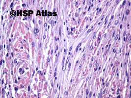8. Fibrous (fibroblastic) meningioma, WHO I, 40x