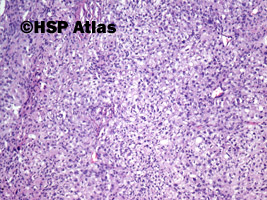 3. Anaplastic meningioma, WHO III, 10x