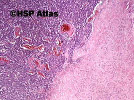 1. Oponiak atypowy (atypical meningioma), WHO II, 4x